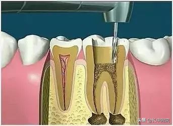 口腔根管治疗技术,口腔根管治疗怎么学好