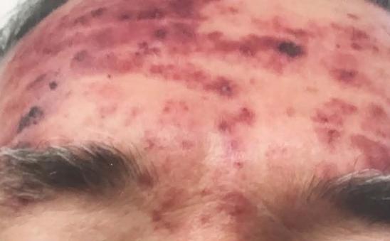 手有伤口被狗舔了会感染狂犬病吗,被狗舔了会有什么风险