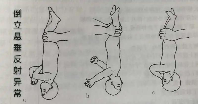 脑瘫儿童的七种异常姿势,判断宝宝脑瘫最简单的方法