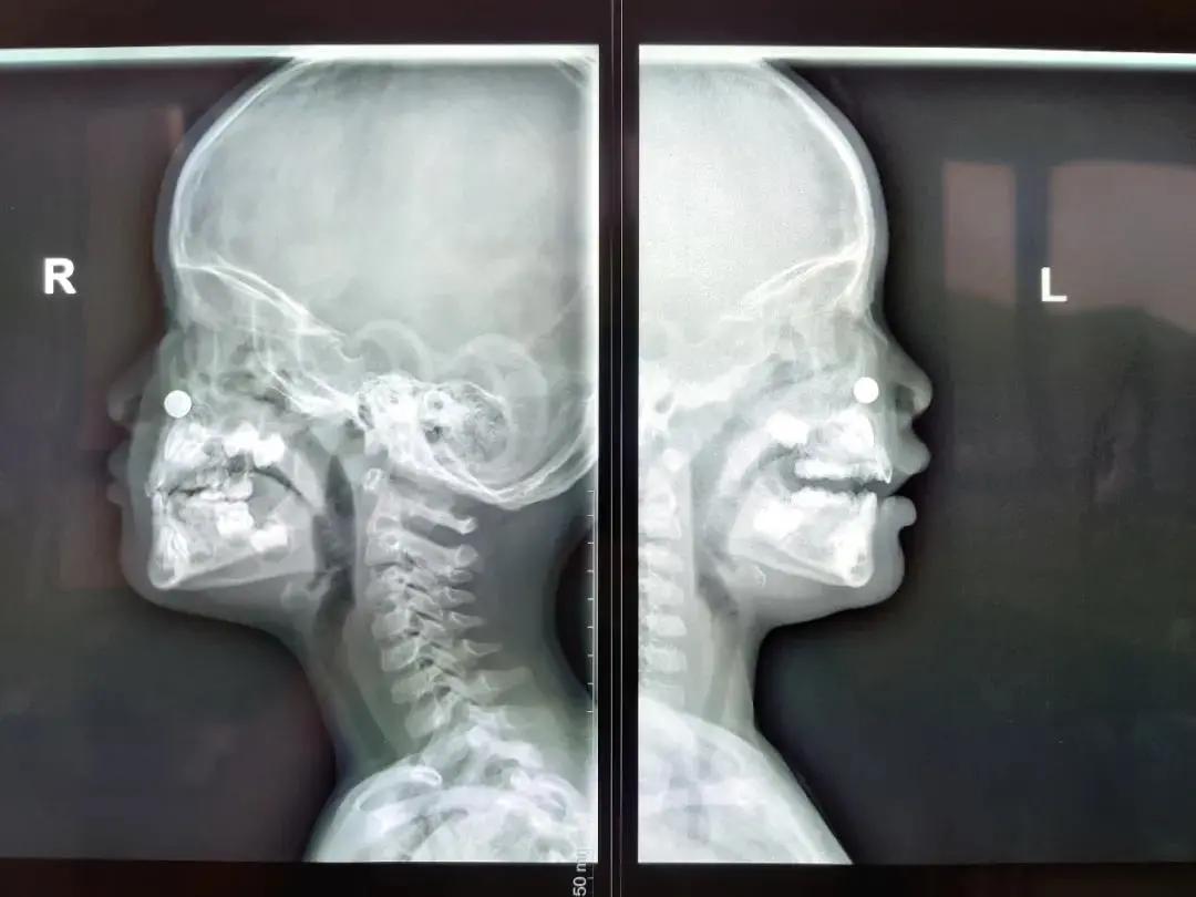 男童鼻子总是不通气,男童鼻子老是不通气