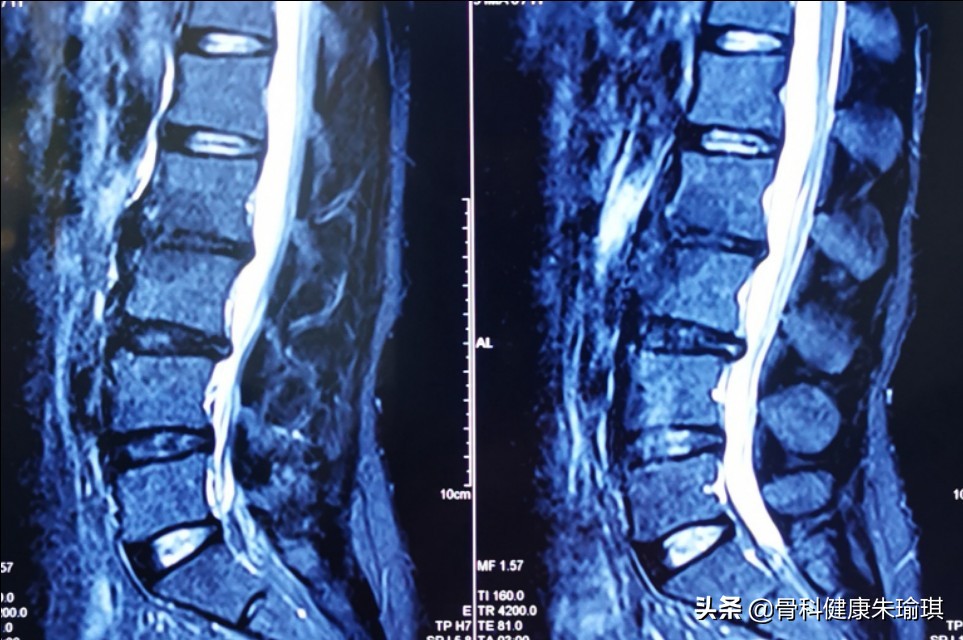 腰椎间盘突出病因的中医解释,腰椎l5s1椎间盘突出症的自我疗法