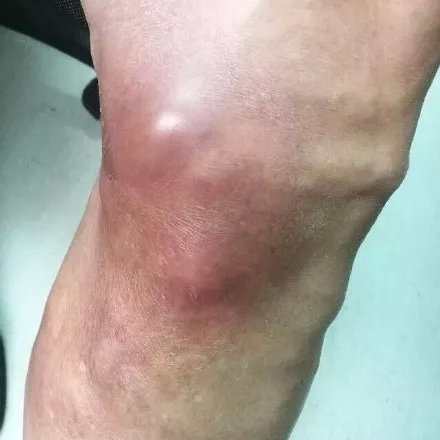 我静脉曲张最近老是疼怎么办,我静脉曲张了应该怎么治疗