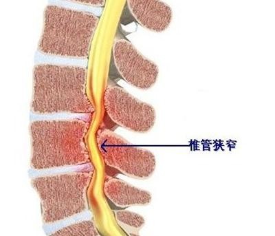 腰疼椎管狭窄压迫神经怎么治疗,腰疼椎管狭窄有什么办法
