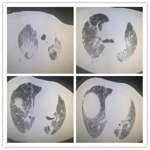 呼吸困难为主要症状的住院大病历,病人出现呼吸困难症状