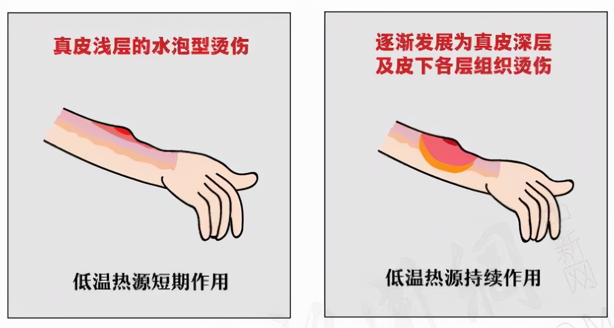 卫生巾治烫伤,卫生巾治疗烫伤