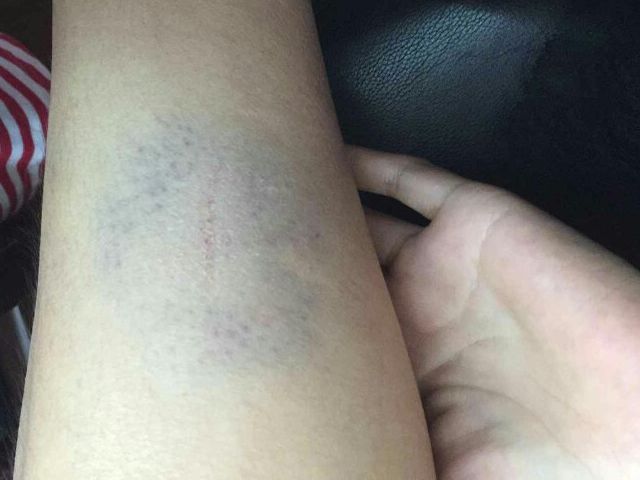 腿部出现血管明显怎么回事,腿部血管有什么反应