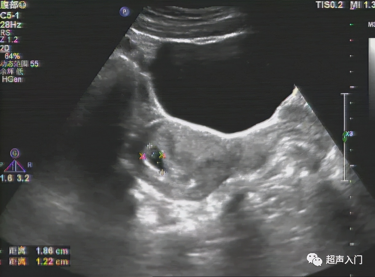 超声如何判断子宫位置,超声上怎么判断子宫后位