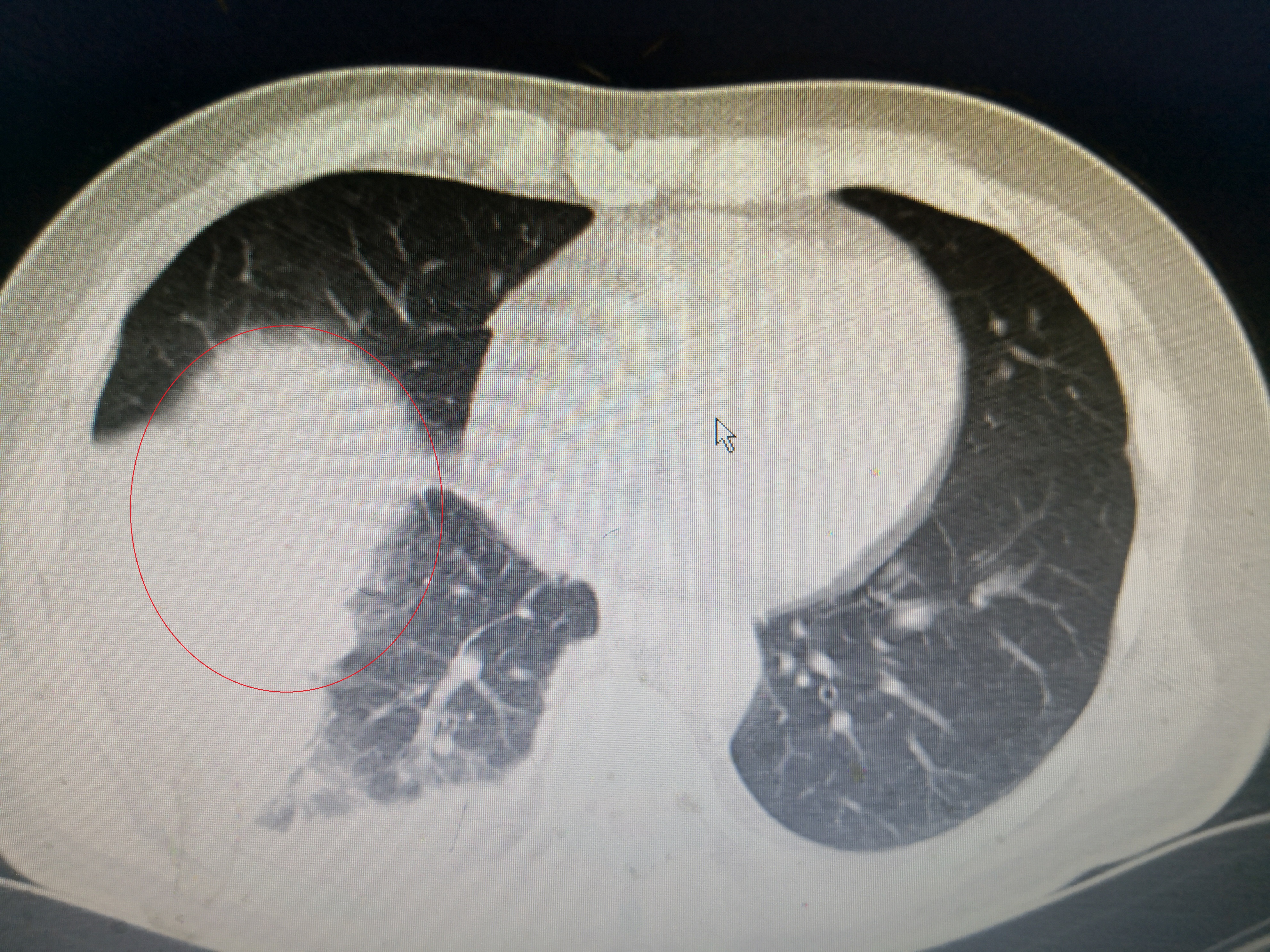 重症肺炎的急救配合要点,重症肺炎针对性护理措施