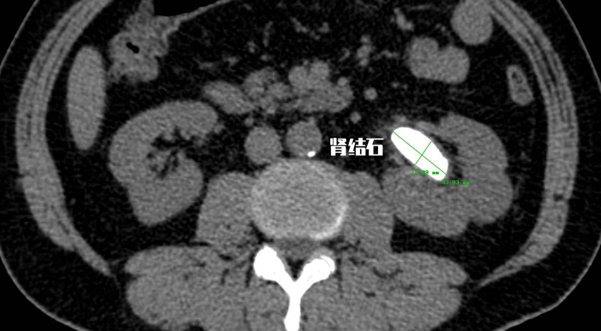 泌尿结石的治疗方法与分类,泌尿系结石的病人