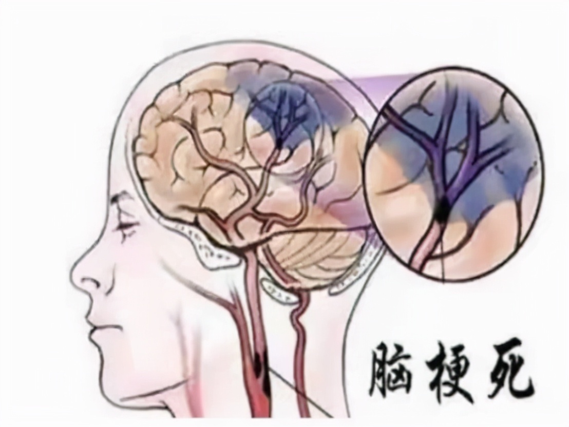脑梗后老年人吃叶酸和维生素b12,脑梗叶酸b6b12能长期吃吗