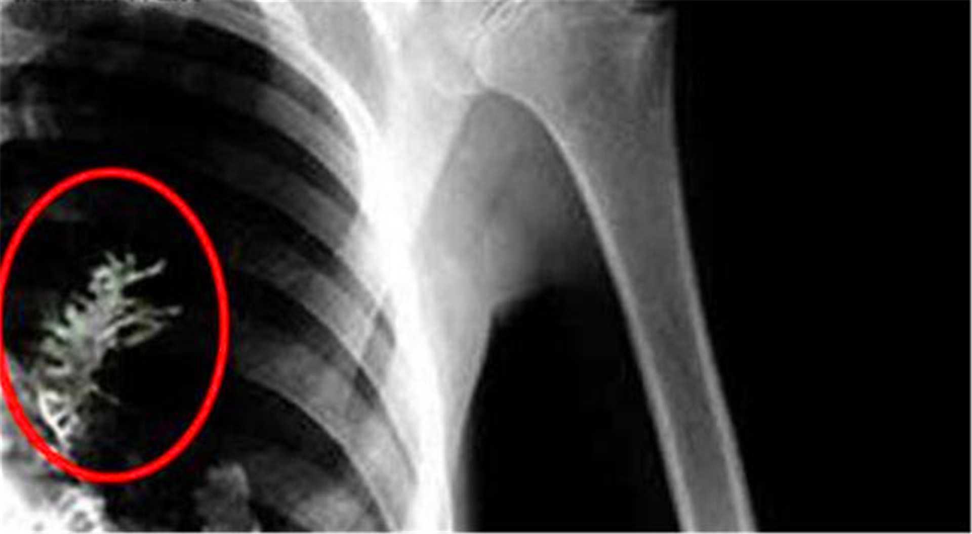 男子确诊肺癌早期被医生劝回,男子肺癌手术发现长了一棵冷杉树