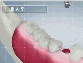 种植牙与烤瓷牙的区别,烤瓷牙和种植牙到底有何区别
