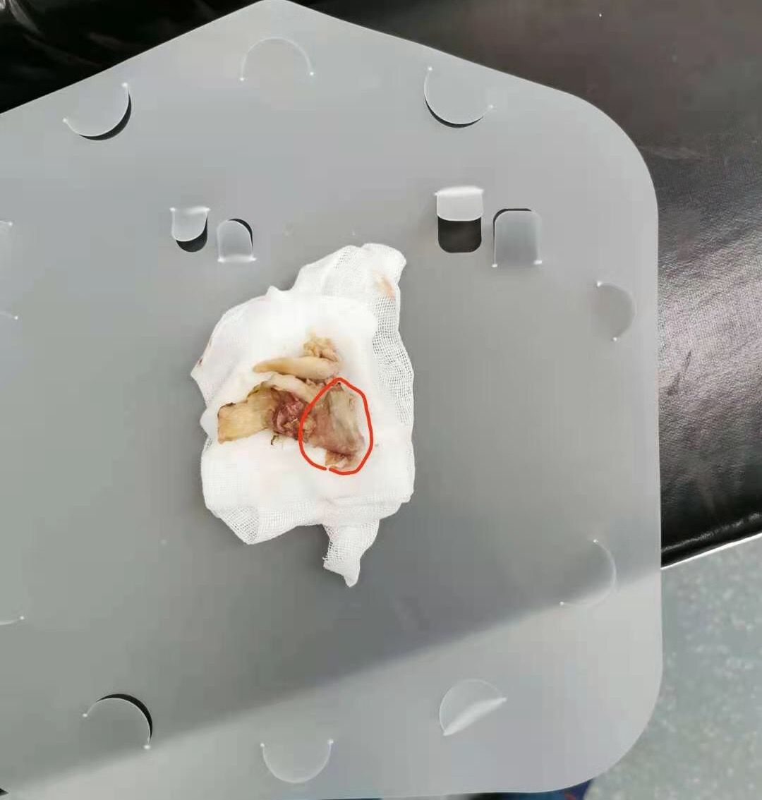 吃鸡骨头造成食道穿孔多久能好,吃骨头误吞导致食道穿孔