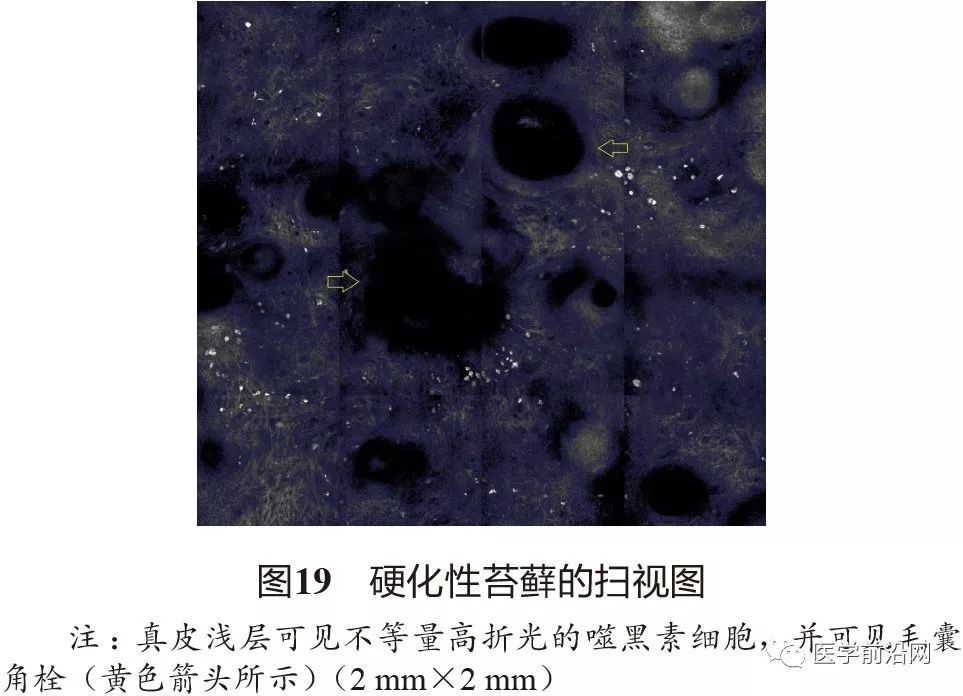 炎症性皮肤病反射式共聚焦显微镜诊断特征专家共识全文发布