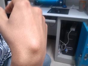 骨科可以治腱鞘囊肿吗,脚腱鞘囊肿最快的恢复办法