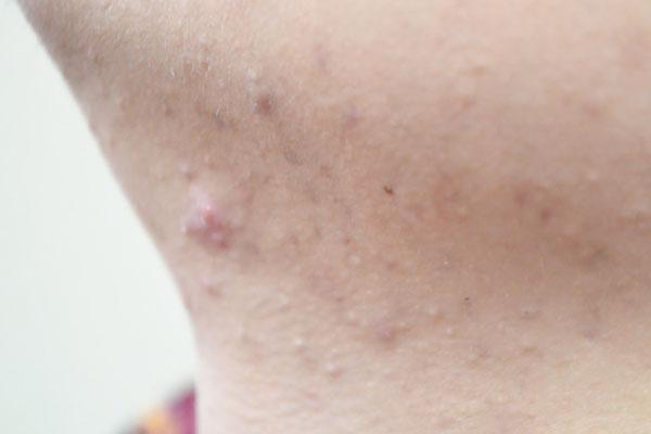 内分泌失调会导致脖子上起疙瘩吗,内分泌失调脖子上会长肉粒吗