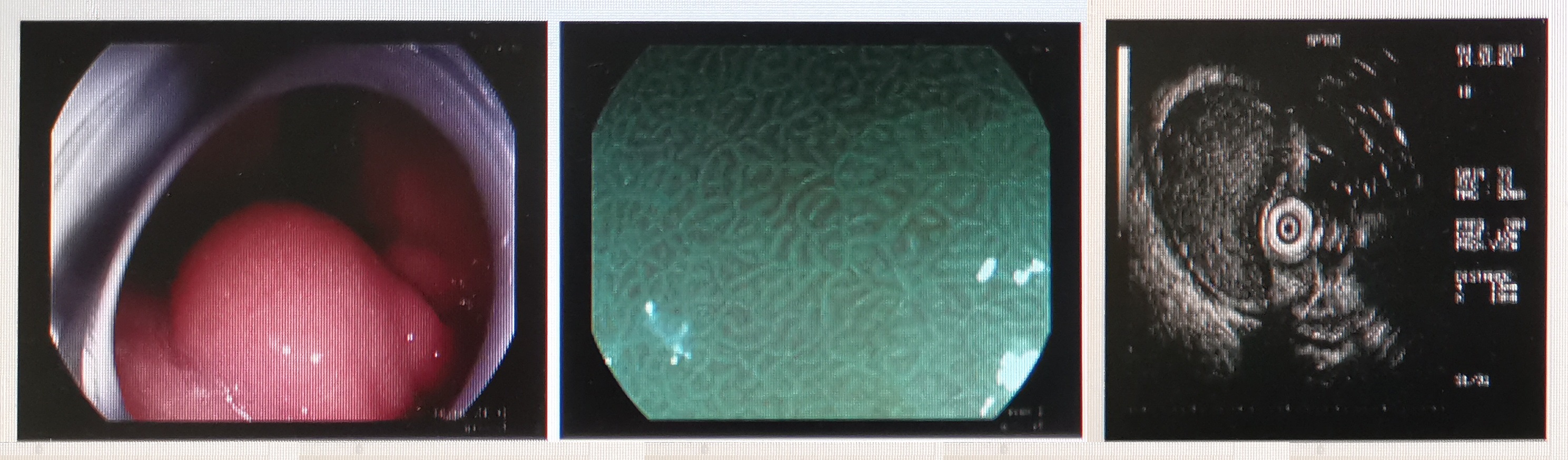 镜界“二郎神”——超声内镜知识科普