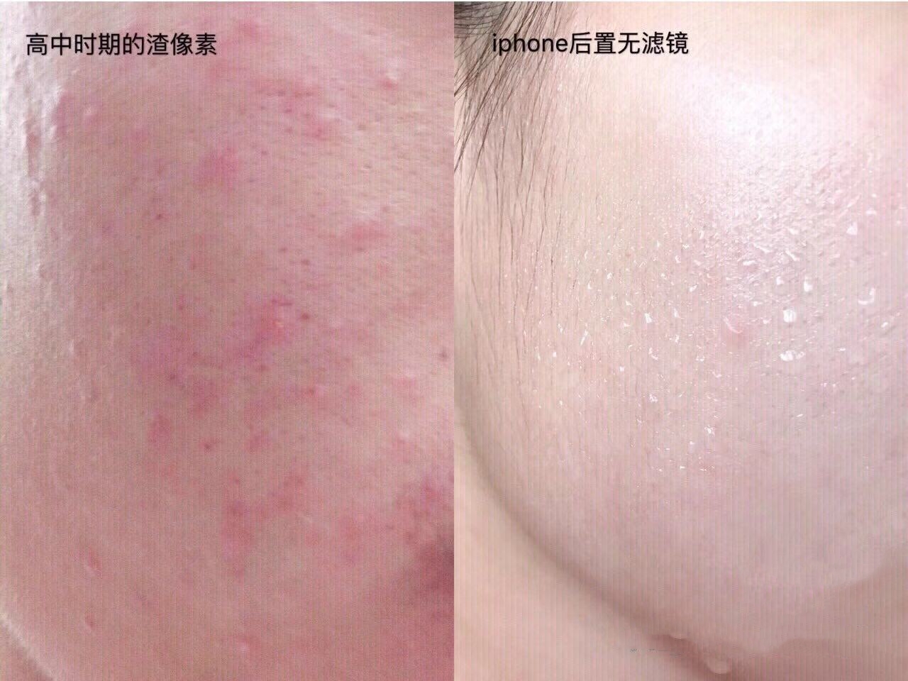 超强祛痘攻略养成不长痘肌肤,祛痘全攻略脸上痘痘真的干净了