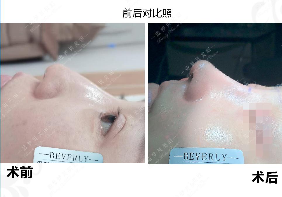 隆鼻术后一个月内可以重新修复吗,专家讲解隆鼻修复手术效果