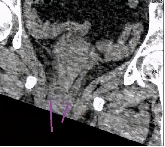 尿路梗阻导致肾积水不及时治疗,双肾积水是尿路梗阻吗