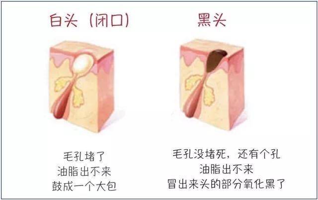 去黑头粉刺简单有效的方法,去黑头粉刺超级治愈
