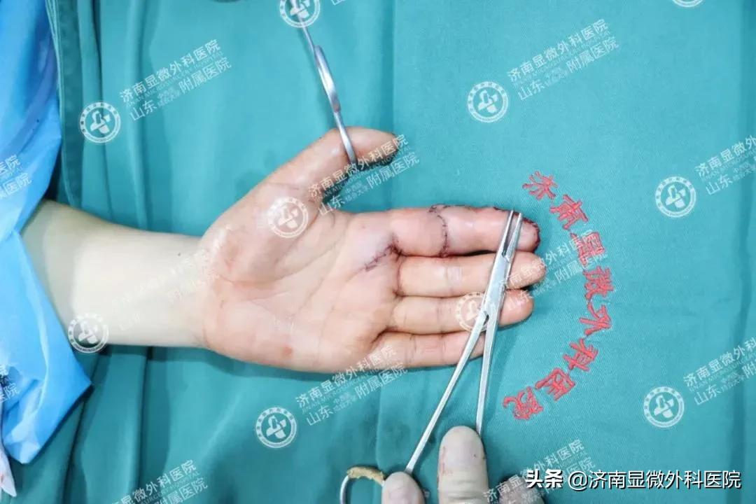 注意！失去一截手指不要灰心，这样做能重新复原它