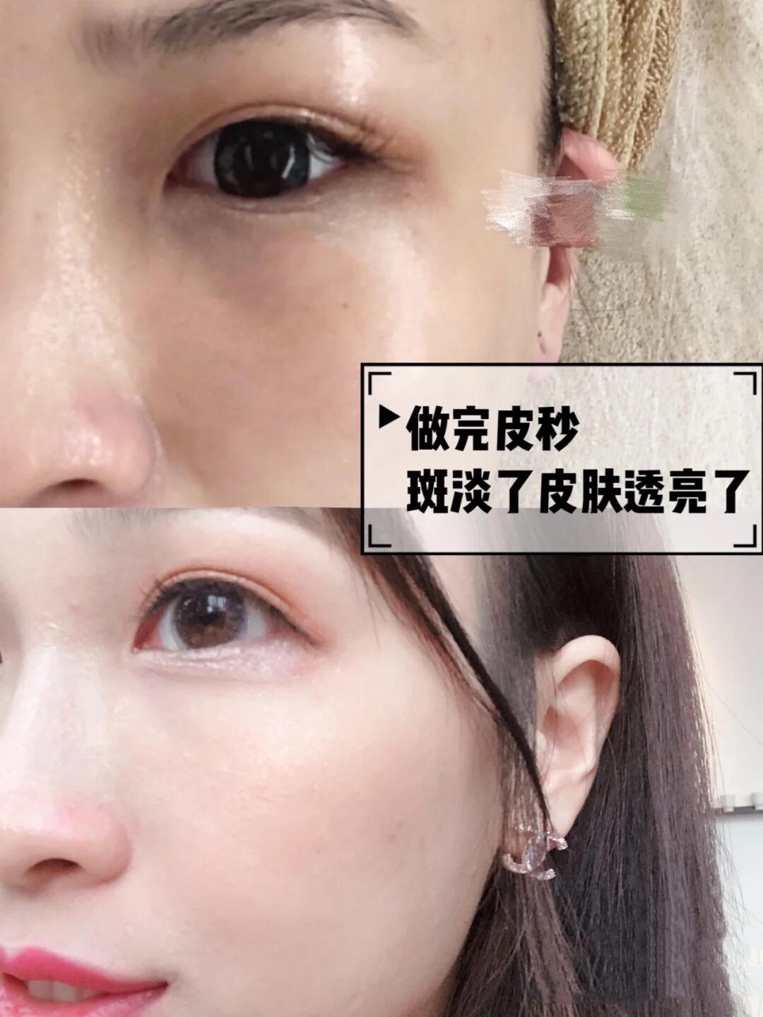 皮秒激光香港,香港祛斑产品推荐