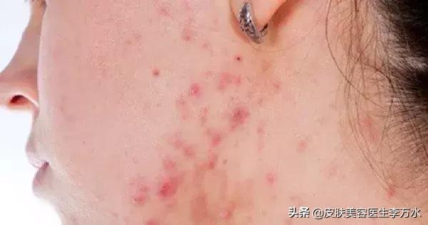 大油皮的坏处是什么,大油皮为啥还起皮