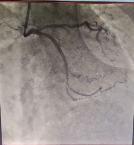 北京积水潭医院心内科成功开展医疗新技术！准分子激光冠脉消蚀术与冠脉旋磨术治疗冠脉钙化病变