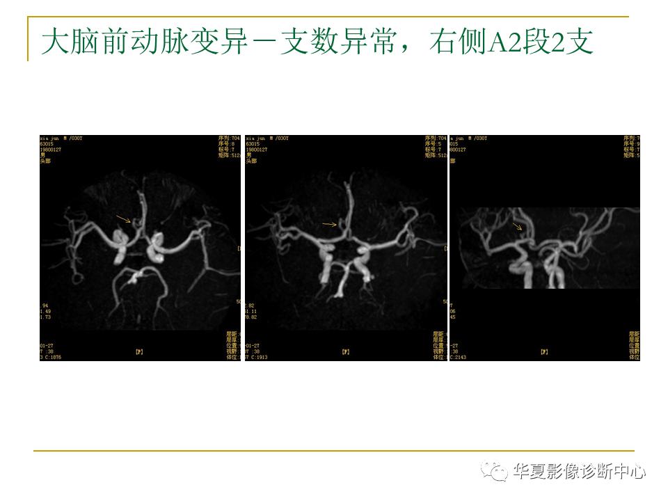 中国人脑立体定向mri应用解剖图谱,脑mri示意图