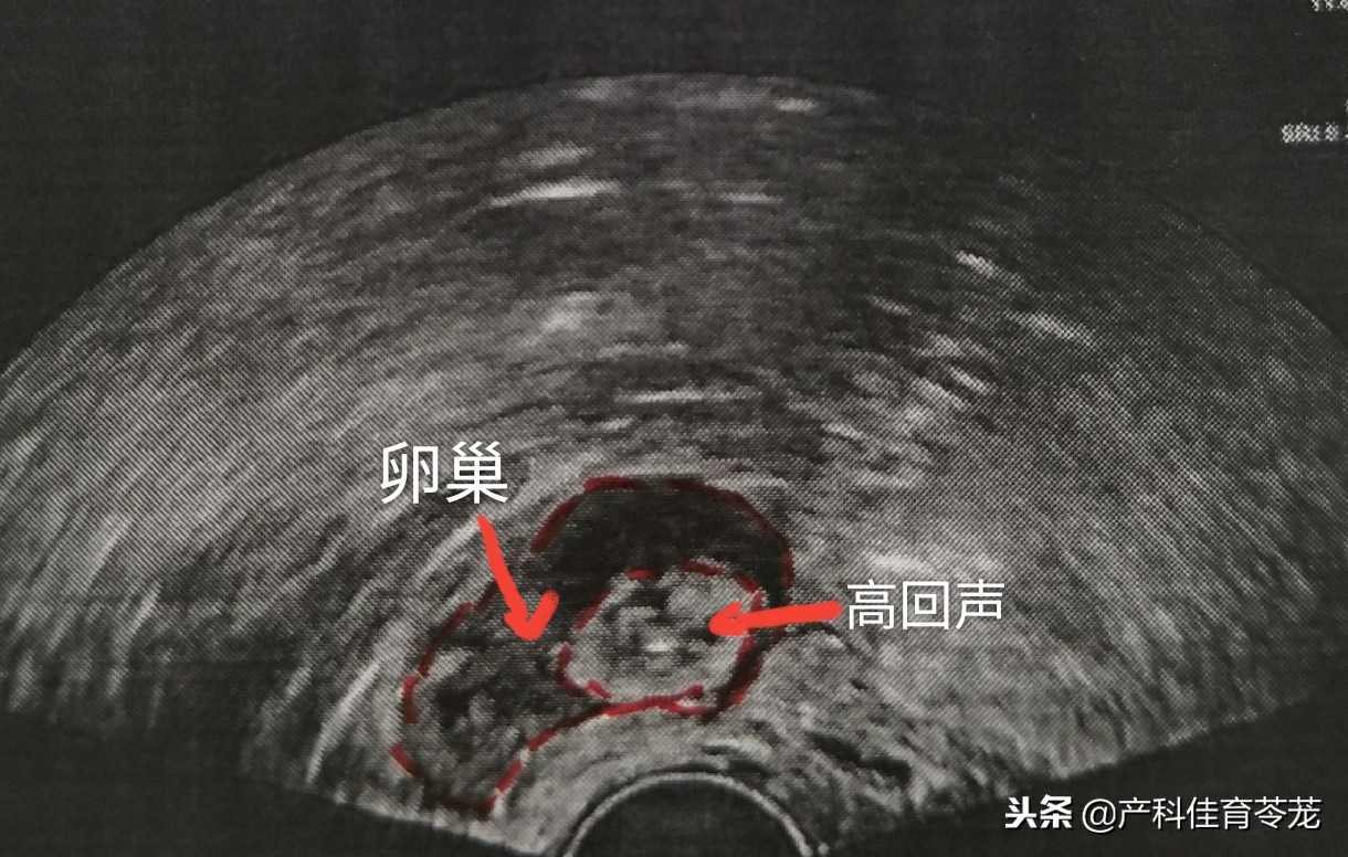 做b超能查卵巢和输卵管异常吗,b超下卵巢大小正常值是多少