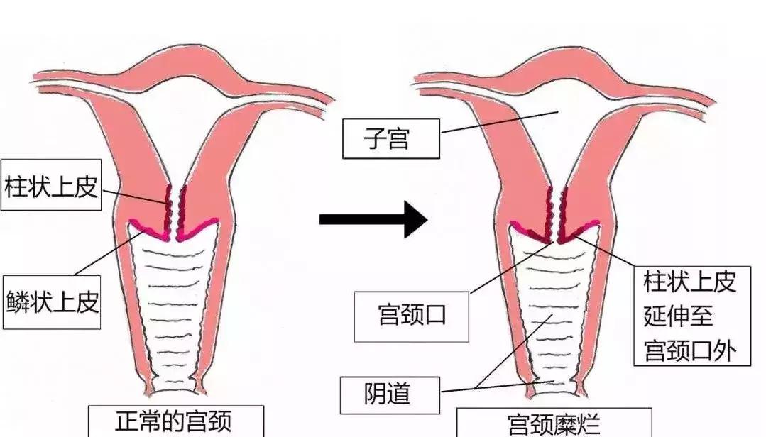 辟谣:这种病距离宫颈癌只有一步之遥?信这个你就被坑了