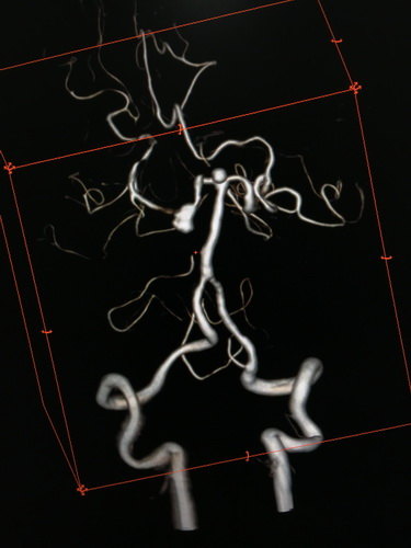 卢旺盛：脉瘤和基底动脉动脉瘤裸栓治疗术后效果非常明显