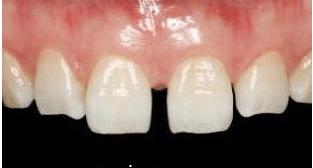 门牙裂了一条缝,门牙有缝的女人