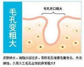 零毛孔让你的皮肤光滑细腻,教你一招搞定毛孔