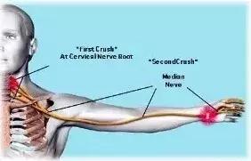 肩周酸痛手发麻如何治疗,肩颈酸痛发麻怎么缓解