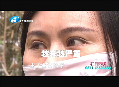 割双眼皮线没有拆干净出脓包了,郑州东方整形医院双眼皮成功案例