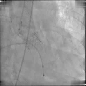 BAV遭遇心脏突然停跳，Sapien3快速植入挽救患者生命