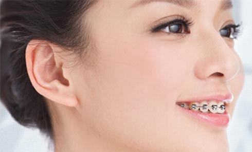 矫正牙齿用哪种牙套效果最好,网上买的矫正牙齿牙套有用吗