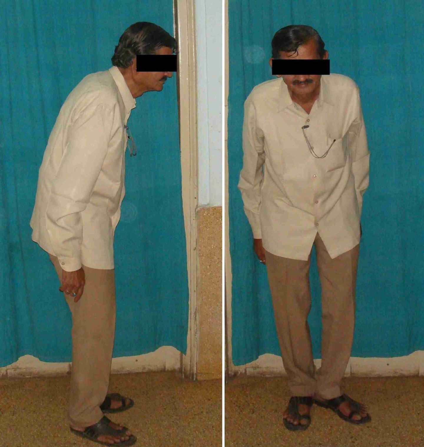 强直性脊柱炎能推拿吗,强直性脊柱炎能做针灸推拿吗