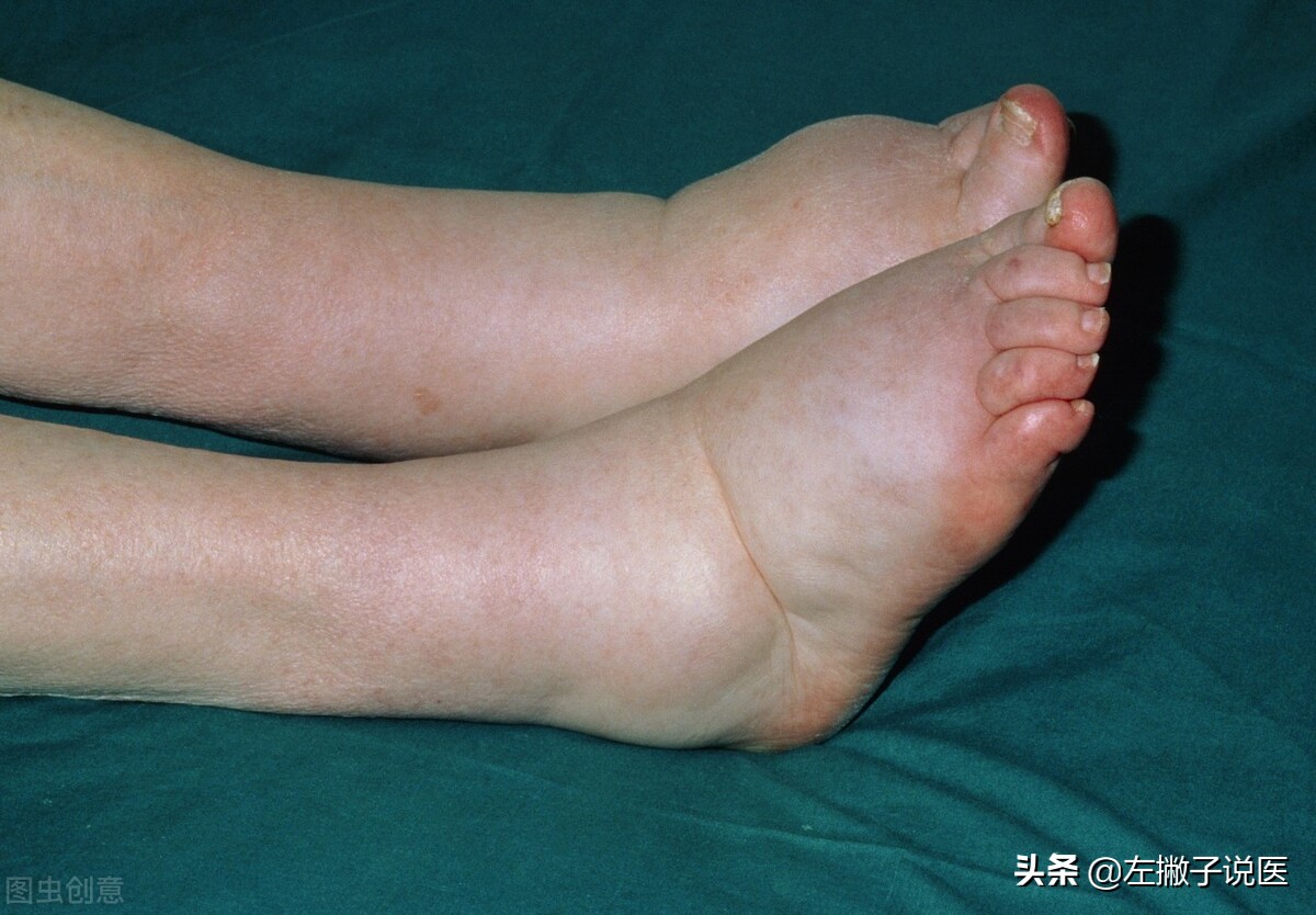 下肢水肿是气虚还是血瘀,下肢水肿是脾的问题还是肾的问题