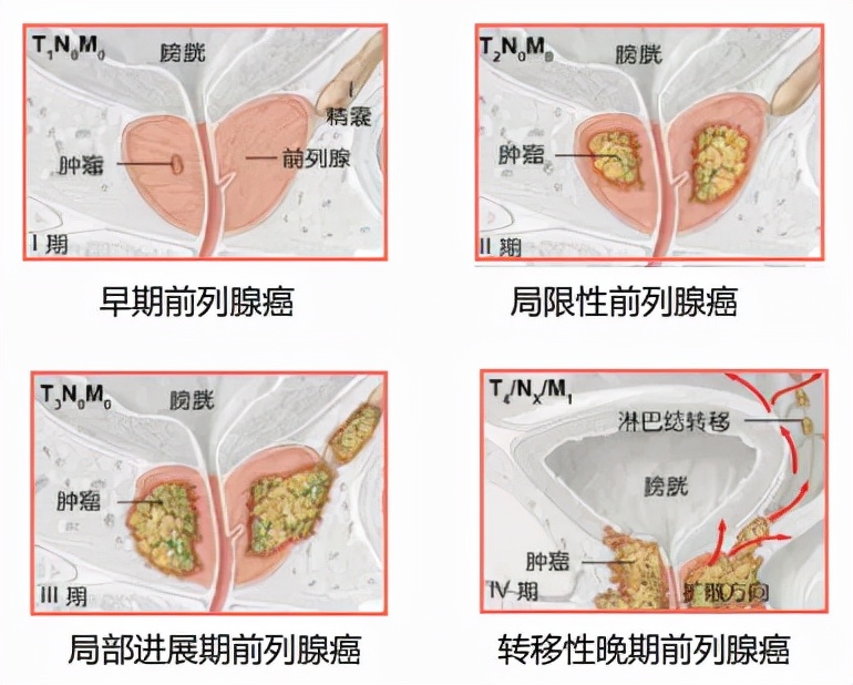 男科前列腺治疗室治疗的经历,腔道介入治疗仪治前列腺炎