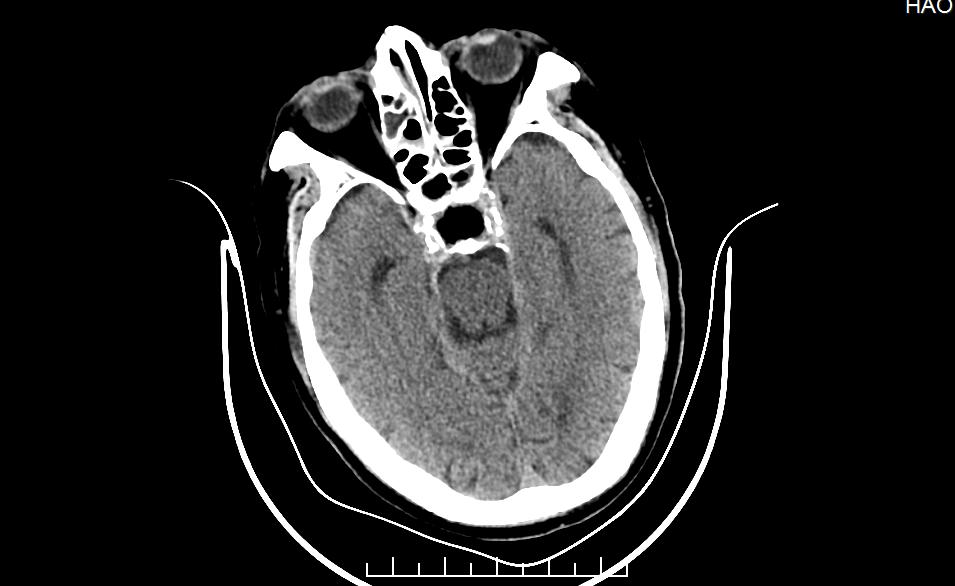 眼突然模糊看不清与大脑有关吗,长时间看不清东西眼睛会变小吗