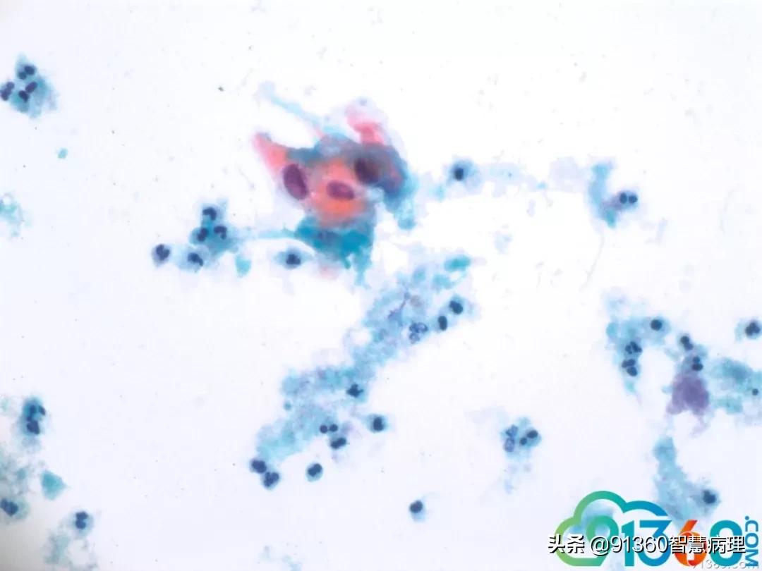 病理宫颈活检lsil是什么意思,宫颈病理检查与tct检查的区别