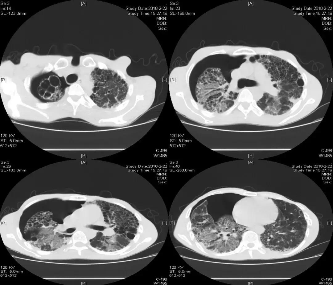 肺纤维化病例,肺纤维化手指甲发紫还能活多久