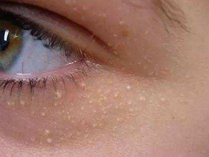 眼睛周围长特别痒小疙瘩怎么回事,女性眼睛周围长疙瘩是什么原因