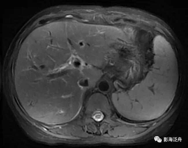 肝脏弥漫性病变严重吗,肝脏弥漫性的病变的症状