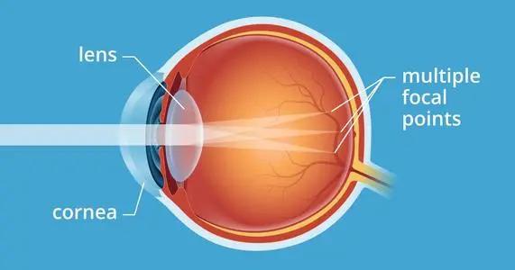 先天性眼睛散光怎么恢复正常,小孩眼睛后天性散光怎么恢复正常