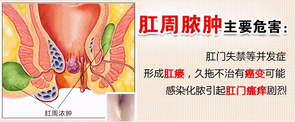 北京肛肠医院治疗肛周脓肿行吗,肛肠医院能治肛周脓肿吗