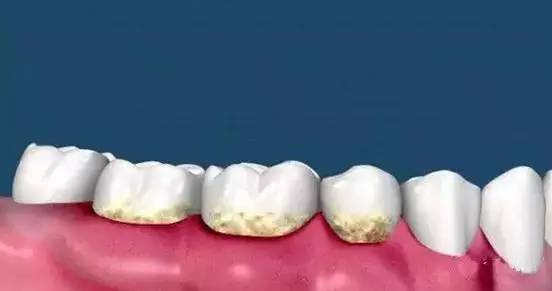 牙齿黑三角要及时修复吗,牙齿黑三角自愈图片